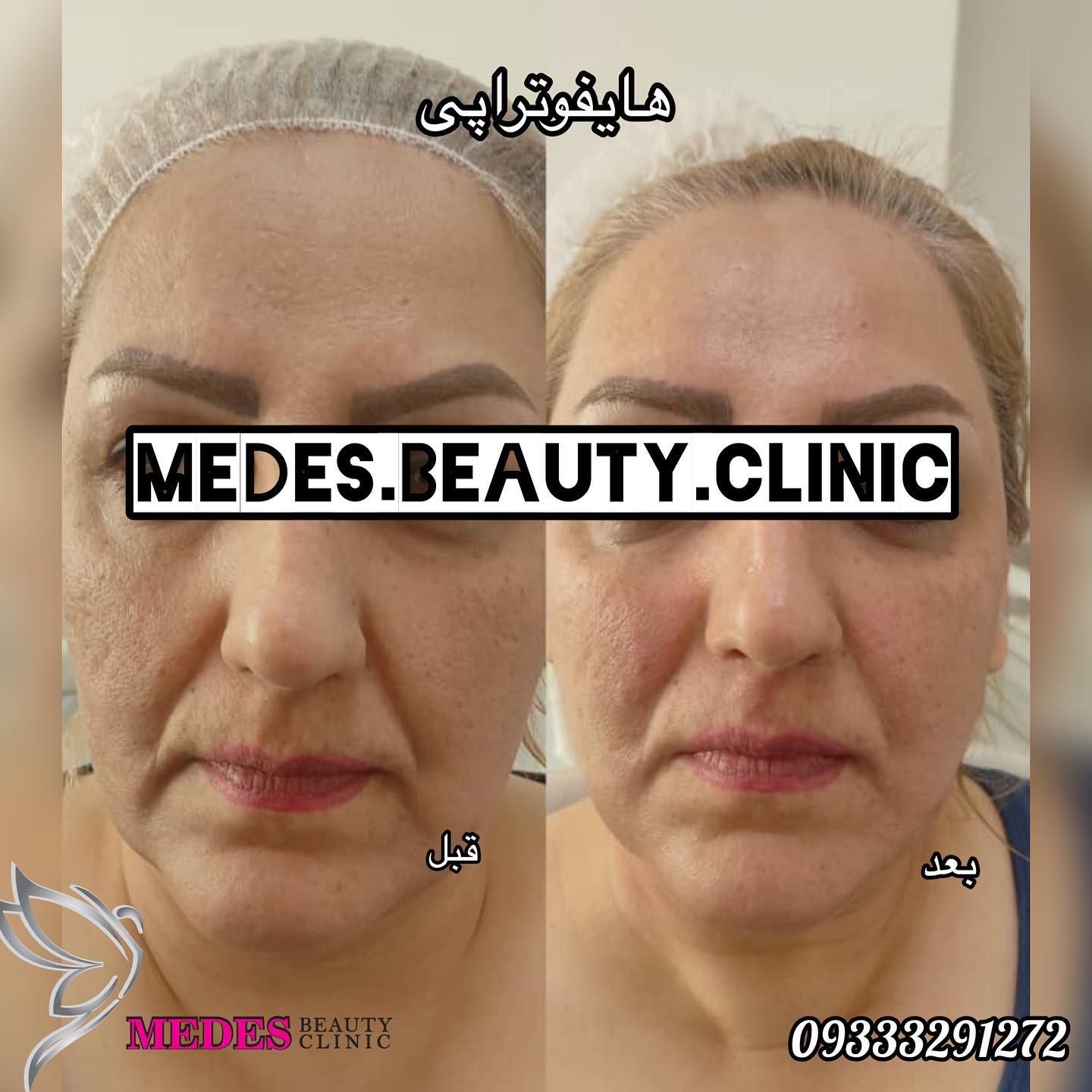 گالری هایفوتراپی